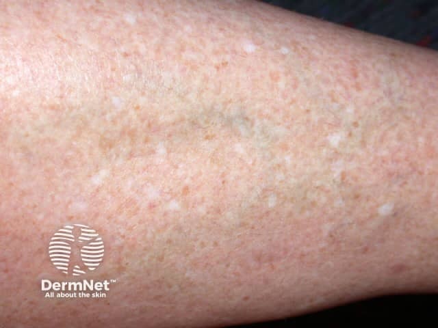 A exposição crônica ao sol pode causar pequenas manchas brancas na pele, principalmente nos braços e pernas. Essas manchas são comuns com o envelhecimento da pele.