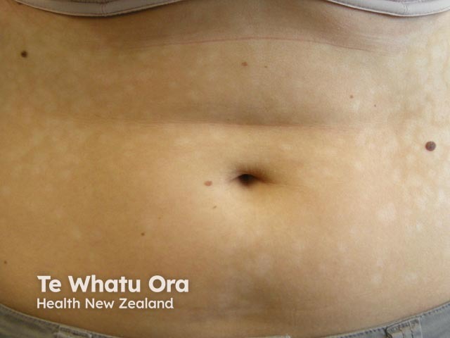 A hipomelanose macular progressiva causa manchas brancas na pele no tronco, principalmente em jovens. As lesões são discretas, sem descamação importante, e podem aumentar com o tempo.