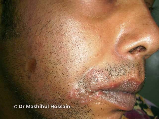 O herpes labial costuma se manifestar como pequenas bolhas cheias de líquido, conhecidas como vesículas, que surgem agrupadas no canto da boca. Essas bolhas aparecem sobre uma região da pele que fica bem vermelha, inchada e sensível ao toque. Geralmente, o processo começa com uma sensação de formigamento ou ardor antes mesmo das lesões ficarem visíveis.