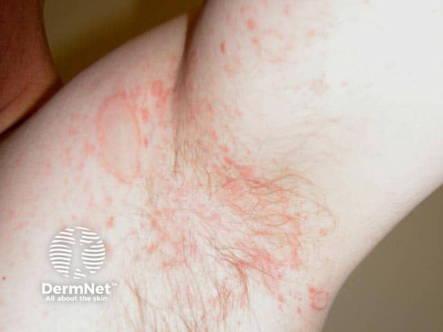 Em alguns casos, a Pitiríase Rósea aparece de forma diferente, atingindo mais as dobras do corpo, sendo chamadas nesses casos de "invertida". Pode surgir nas axilas, virilha e outras regiões flexurais, com manchas semelhantes, mas fora do padrão mais comum.
