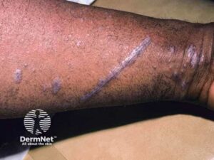 As estrias de Wickham são finas linhas esbranquiçadas, semelhantes a uma teia de aranha, que aparecem na superfície das lesões do Líquen Plano. Elas são causadas por um aumento da camada granular da pele e ajudam muito os médicos no diagnóstico visual. Na prática, é como se a inflamação desenhasse um rendilhado claro por cima da Mancha avermelhada.