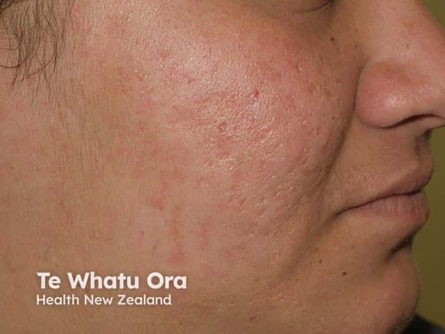 A acne da mulher adulta pode deixar cicatrizes no rosto, principalmente quando as lesões são mais profundas ou manipuladas. Essas marcas podem ser permanentes se não tratadas adequadamente.