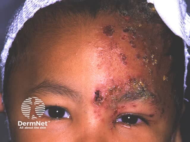 O Herpes Zoster é mais comum em adultos, principalmente após os 50 anos. Em crianças, ele é raro, mas pode acontecer, geralmente em quem já teve catapora muito cedo. Quando aparece, costuma ser mais leve, com menos dor e lesões menos intensas.