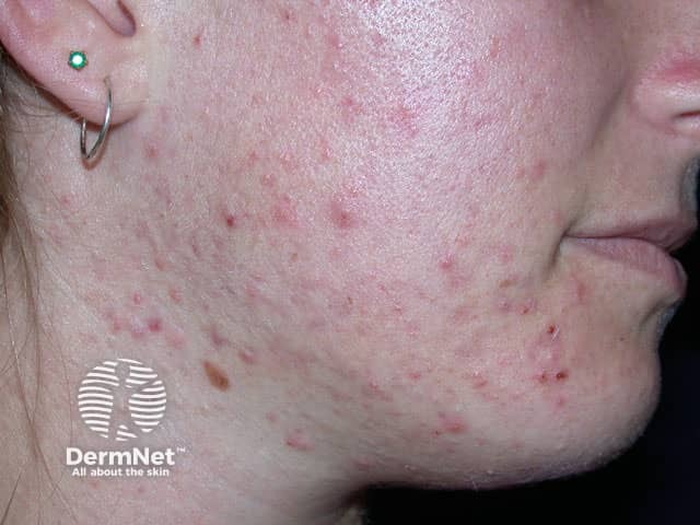 A acne da mulher adulta costuma aparecer mais na parte inferior do rosto, como queixo, mandíbula e pescoço. Essa distribuição é bem típica e diferente da acne da adolescência.