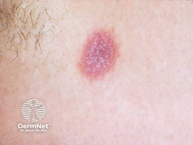 As estrias de Wickham são finas linhas esbranquiçadas, semelhantes a uma teia de aranha, que aparecem na superfície das lesões do Líquen Plano. Elas são causadas por um aumento da camada granular da pele e ajudam muito os médicos no diagnóstico visual. Na prática, é como se a inflamação desenhasse um rendilhado claro por cima da Mancha avermelhada.