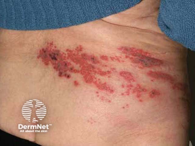 Ao contrário do herpes simples, que causa pequenas feridas localizadas, o herpes-zóster se manifesta como uma faixa de bolhas que segue o caminho de um nervo específico. Essa erupção aparece em apenas um lado do corpo ou do rosto, causando uma dor intensa que parece uma queimação ou fisgada na região afetada. Enquanto o herpes comum pode surgir em vários pontos, o zóster respeita rigorosamente essa linha nervosa, "desenhando" um cinturão na pele.