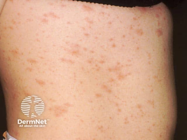 Na Pitiríase Rósea, as lesões costumam ser ovaladas e aparecem principalmente no tronco. Em alguns casos, a “placa mãe” não é percebida, e as manchas surgem diretamente, mesmo assim mantendo o padrão típico da doença.