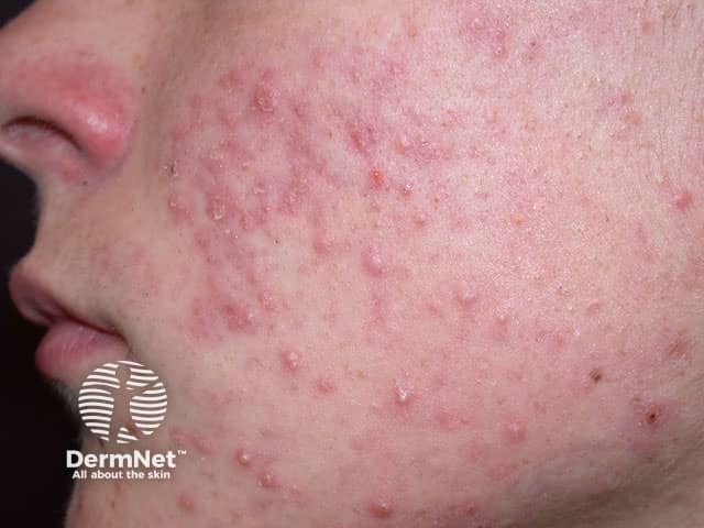 No grau 2 da acne da mulher adulta, já existem cravos e espinhas inflamadas, com pápulas e algumas pústulas. É um quadro moderado, que costuma precisar de tratamento específico.