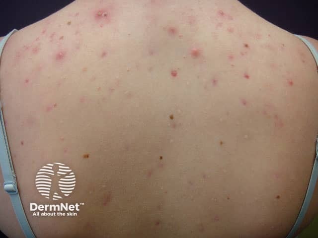 Embora seja mais comum no rosto, a acne da mulher adulta também pode causar lesões nas costas e no colo. Essas áreas podem apresentar espinhas inflamadas semelhantes às do rosto.