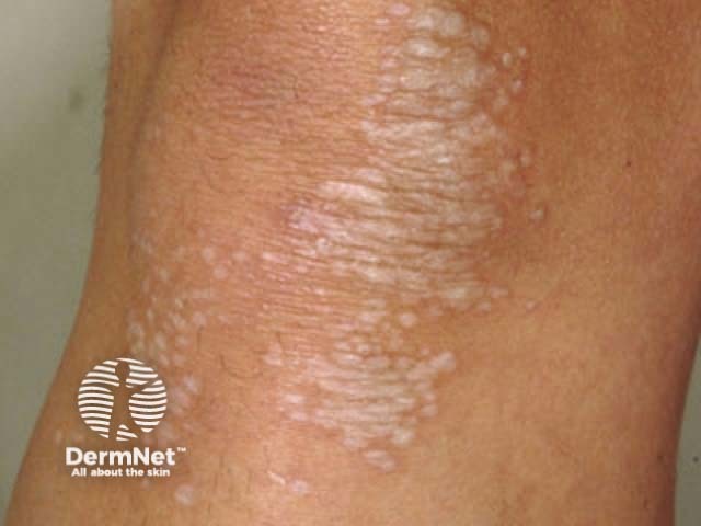 O líquen escleroso pode causar manchas brancas na pele, geralmente em áreas íntimas. A pele pode ficar mais fina, sensível e com aspecto esbranquiçado.