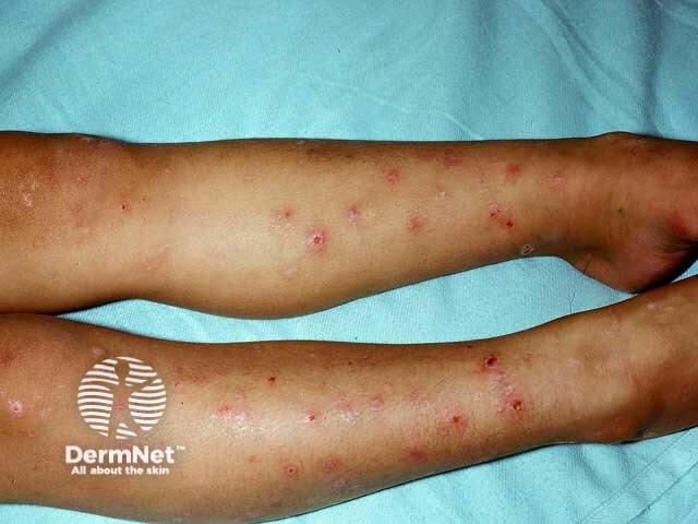 As pernas também são locais frequentes do Prurigo Estrófuloo, principalmente em crianças. As lesões costumam surgir como pápulas avermelhadas, muito pruriginosas, especialmente após novas picadas.