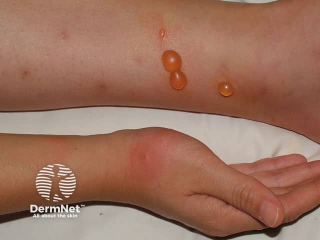 Em alguns casos, o Prurigo Estrófuloo pode não se manifestar apenas com bolinhas. Pequenas bolhas e vesículas também podem aparecer, mostrando uma reação mais intensa da pele à picada.