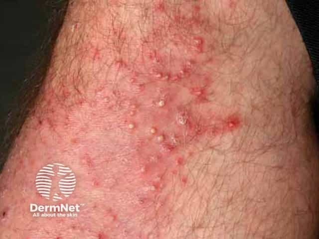 A Foliculite surge em áreas pilosas porque é uma inflamação do folículo do pelo. Por isso, pode aparecer na barba, couro cabeludo, pernas, tórax e outras regiões com pelos.