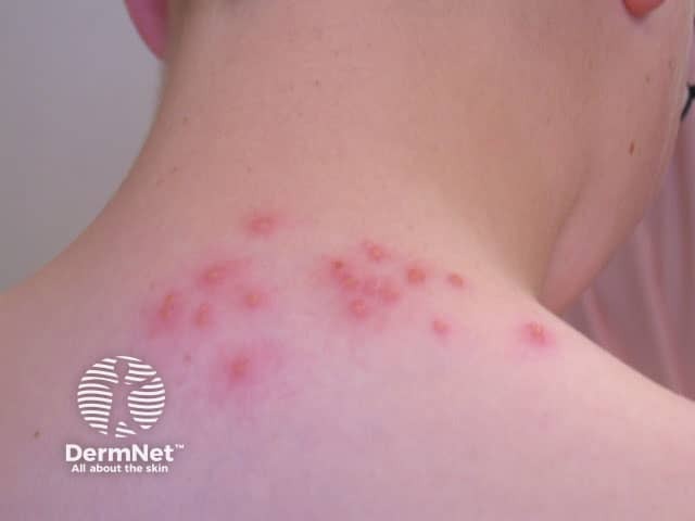 Quando o Prurigo Estrófuloo aparece com lesões agrupadas ou em linha, é importante pensar em picadas de percevejos de cama, chamadas de bedbugs ou cimidíase. Esse padrão repetido pode ajudar a identificar a causa.