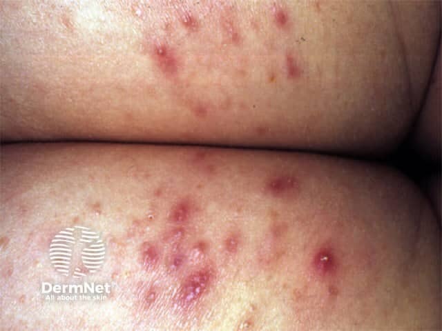 A Foliculite também pode ocorrer nas nádegas, favorecida por suor, roupas apertadas e atrito local. Nessa área, as bolinhas podem incomodar bastante ao sentar.