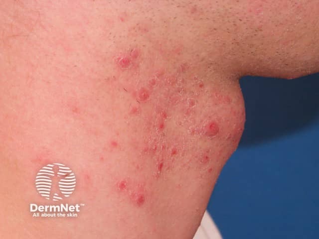 A Pseudofoliculite da barba é comum em homens após o barbear, principalmente quando o pelo encrava ou há irritação da pele. Ela aparece como pequenas bolinhas vermelhas ou pústulas na região da barba, muitas vezes centradas no pelo.