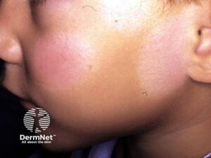 A Pitiríase alba é muito comum em crianças e adolescentes. Ela costuma aparecer principalmente no rosto, causando manchas mais claras que chamam mais atenção após exposição ao sol.