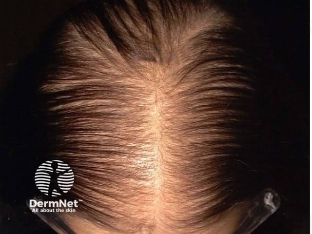A Alopecia androgenética feminina causa afinamento progressivo dos fios, principalmente no topo da cabeça. Muitas mulheres percebem aumento da risca central e redução do volume do cabelo ao longo do tempo.