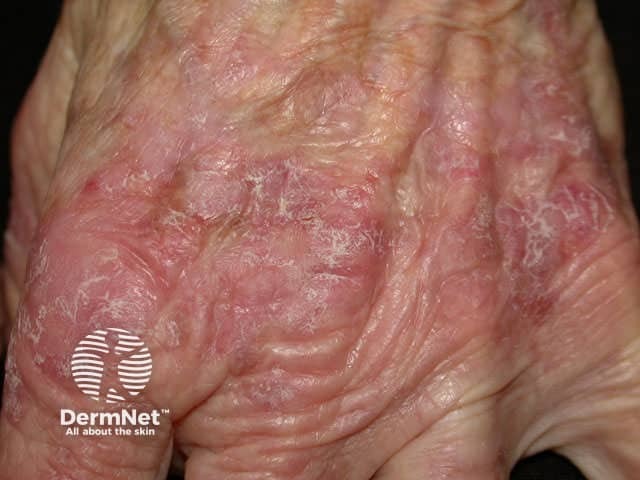 A Ceratose Actínica aparece com frequência no dorso das mãos, uma área muito exposta ao sol ao longo da vida. As lesões costumam ser ásperas ao toque e podem passar despercebidas no início.