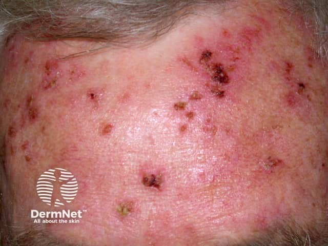 Durante o tratamento da Ceratose Actínica com fluoracila, é comum surgirem áreas vermelhas, inflamadas e com crostas. Isso acontece porque o medicamento destaca e trata lesões que muitas vezes ainda não eram visíveis a olho nu.