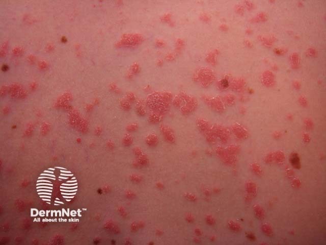 A Psoríase na forma gutata aparece como várias pequenas manchas avermelhadas espalhadas pelo corpo. Esse tipo é mais comum em crianças e jovens, muitas vezes após infecções de garganta.