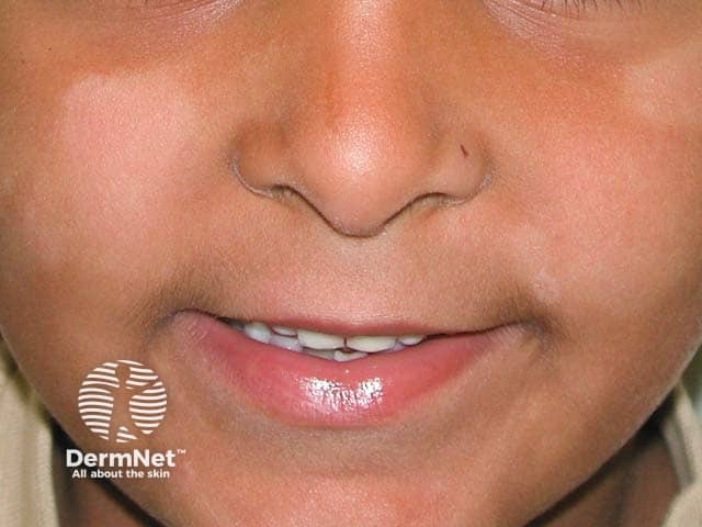 Na Pitiríase alba, as manchas têm bordas mal definidas, diferente do vitiligo, que costuma ter limites bem nítidos. Esse detalhe ajuda bastante na diferenciação entre as duas condições.