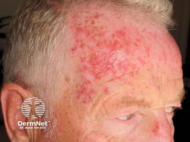 No tratamento da Ceratose Actínica, a fluoracila costuma provocar uma inflamação intensa na pele. Embora o aspecto possa impressionar, essa reação geralmente indica que o medicamento está atuando nas áreas danificadas pelo sol.