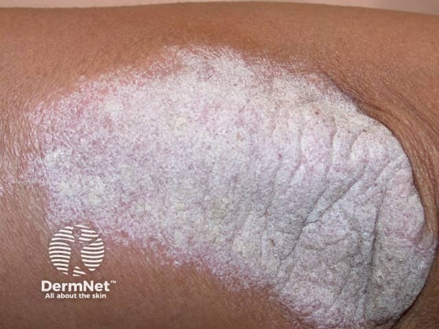 Uma característica típica da Psoríase é a descamação esbranquiçada ou prateada sobre as lesões. Essas escamas podem se soltar facilmente e deixar a pele sensível.
