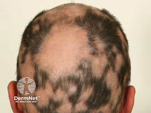 Na alopecia areata, a Alopecia costuma surgir como falhas arredondadas e bem delimitadas no couro cabeludo. A pele da região geralmente fica lisa, sem descamação ou feridas.