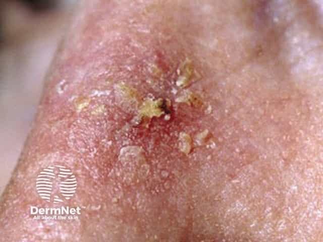 Na Ceratose Actínica, é comum observar escamas secas e pequenas crostas sobre a pele. Muitas pessoas percebem a lesão primeiro pelo toque áspero, antes mesmo de enxergá-la claramente.