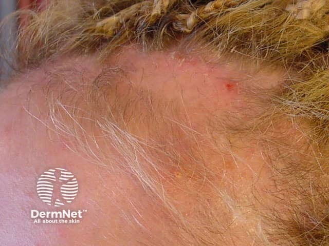 A Alopecia de tração acontece pelo puxamento repetido dos fios, comum em penteados muito apertados. Coques, tranças e rabos de cavalo muito tensionados podem levar à queda progressiva dos cabelos.