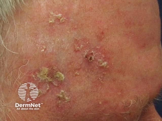 A testa é outra região frequentemente afetada pela Ceratose Actínica. A exposição solar acumulada ao longo dos anos favorece o aparecimento dessas áreas ásperas e descamativas.