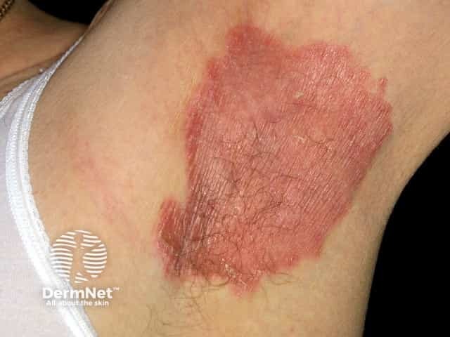 Na forma invertida, a Psoríase surge nas dobras do corpo, como as axilas e virilha. Nessas regiões, a pele fica mais avermelhada e úmida, geralmente com pouca descamação.