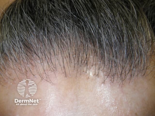 Na alopecia fibrosante frontal, um tipo cicatricial de Alopecia, ocorre perda dos fios da linha frontal e também dos pelos finos (“velus”) da testa. As sobrancelhas também podem ficar mais ralas.