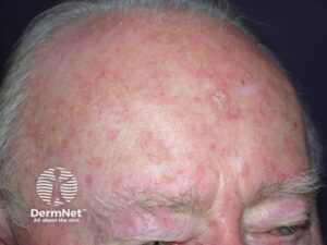 A testa é outra região frequentemente afetada pela Ceratose Actínica. A exposição solar acumulada ao longo dos anos favorece o aparecimento dessas áreas ásperas e descamativas.