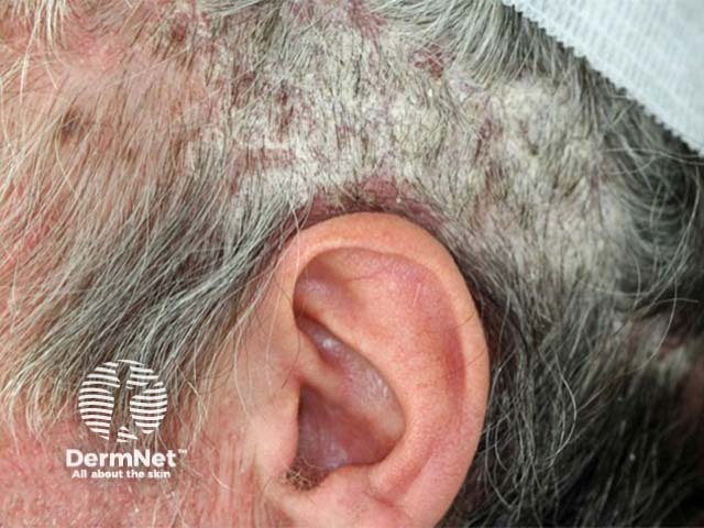 A Psoríase pode atingir o couro cabeludo, causando placas vermelhas e muita descamação. Em alguns casos, as escamas lembram caspa intensa.