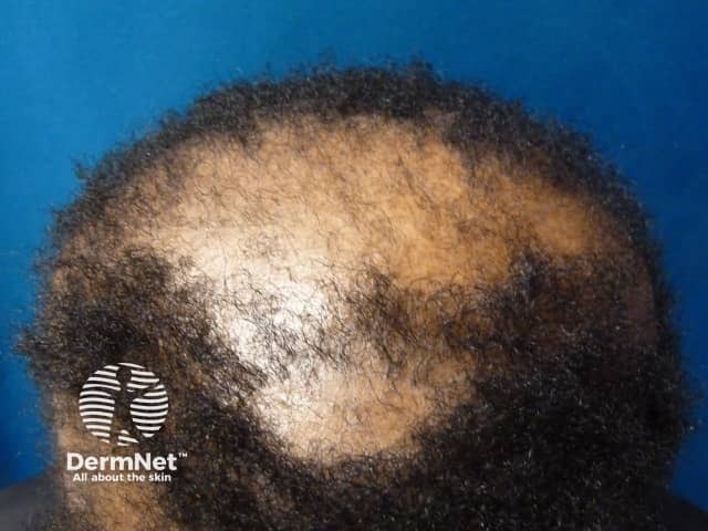 A Alopecia central cicatricial centrífuga costuma começar no centro do couro cabeludo e avançar lentamente para as laterais. Sua principal característica é a perda permanente dos fios por formação de cicatriz na região afetada.