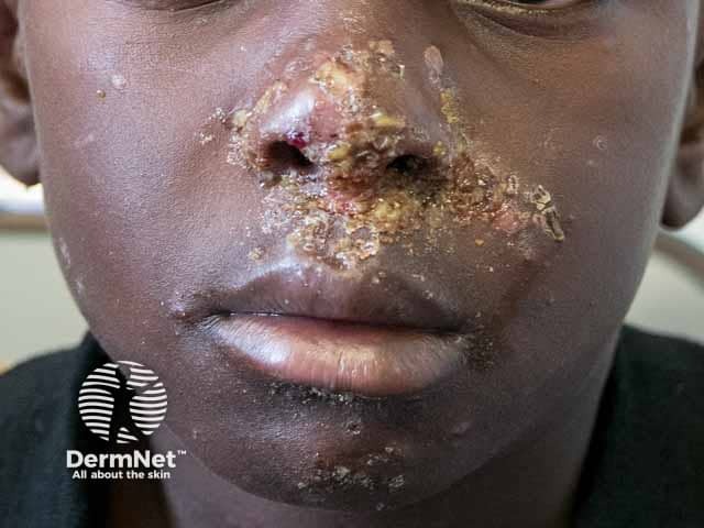 O Impetigo é muito comum ao redor do nariz e da boca das crianças. Nesses locais, surgem pequenas feridas que rapidamente formam crostas amareladas características.
