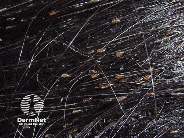 As lêndeas do piolho são pequenos ovos esbranquiçados ou amarronzados que ficam firmemente aderidos ao fio de cabelo. Diferente da caspa, elas não saem facilmente ao passar a mão.