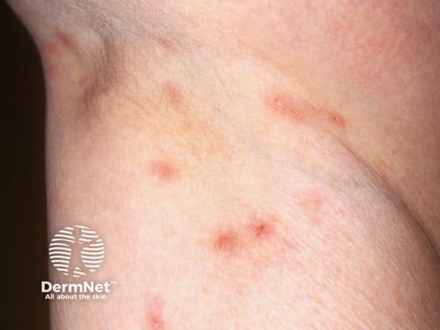A escabiose pode causar pequenas bolinhas e intensa coceira nas axilas. Essa é uma das regiões mais frequentemente acometidas, principalmente em adolescentes e adultos.
