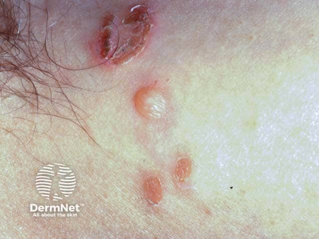 O Impetigo na forma bolhosa é mais comum em crianças pequenas. Ele provoca bolhas cheias de líquido que se rompem facilmente, deixando áreas avermelhadas e crostas na pele.