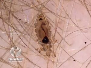 O piolho adulto se alimenta de sangue do couro cabeludo. Após a alimentação, é possível observar um conteúdo escuro ou avermelhado em seu interior, correspondente ao sangue ingerido.