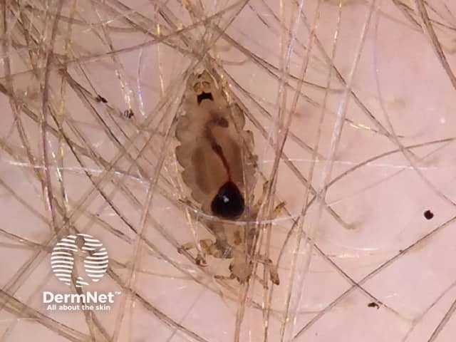 O piolho adulto se alimenta de sangue do couro cabeludo. Após a alimentação, é possível observar um conteúdo escuro ou avermelhado em seu interior, correspondente ao sangue ingerido.
