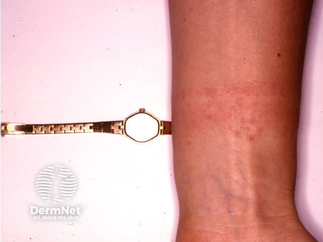 A Dermatite de Contato é comum na região da pulseira do relógio, principalmente quando há alergia ao níquel presente em alguns metais. A pele pode ficar avermelhada, descamar e causar bastante coceira.