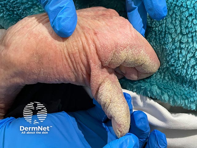 A escabiose pode se apresentar na forma crostosa, também chamada de sarna norueguesa. Nessa variante, há grande quantidade de ácaros, placas espessas e crostas, sendo mais comum em pessoas com imunidade reduzida.