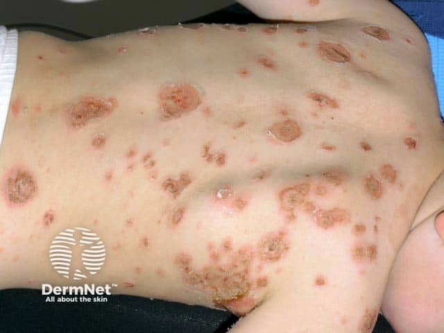 Em alguns casos, o Impetigo bolhoso pode se espalhar por várias regiões do corpo. Quando isso acontece, é importante procurar atendimento médico para avaliar a extensão das lesões e indicar o tratamento mais adequado.