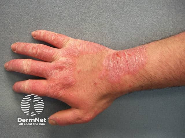 Algumas pessoas desenvolvem Dermatite de Contato por componentes presentes em borrachas, como as de luvas, elásticos ou calçados. As lesões aparecem nas áreas que permanecem em contato com o material.