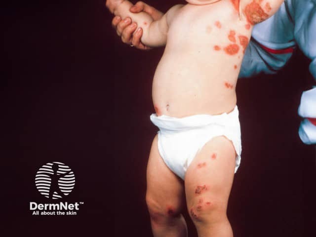 O Impetigo pode formar lesões "em beijo" nas axilas, quando áreas de pele em contato transmitem a infecção uma para a outra. Esse padrão também pode ser observado em outras regiões de dobras.