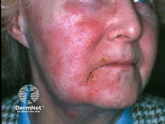 Embora seja um produto natural, o óleo de lavanda também pode causar Dermatite de Contato em pessoas sensíveis. Após a aplicação, podem surgir vermelhidão, coceira e irritação na região da pele exposta.