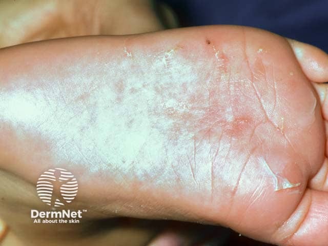 Nas crianças, a escabiose pode atingir as plantas dos pés, o que é muito menos comum em adultos. Nessa região, além das bolinhas avermelhadas, podem surgir pequenas vesículas (bolhinhas com líquido), um achado bastante característico dessa faixa etária.